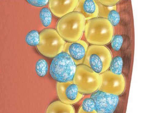 Después del tratamiento, el sistema inmunitario elimina poco a poco las células grasas